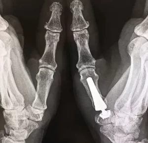 Radiografía, prótesis, articulación pulgar